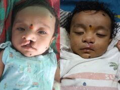 जन्मजात कटे होंठ का निःशुल्क सफल ऑपरेशन, अब सामान्य रूप से कर रहा स्तनपान