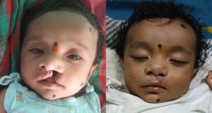 जन्मजात कटे होंठ का निःशुल्क सफल ऑपरेशन, अब सामान्य रूप से कर रहा स्तनपान