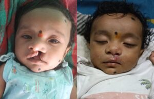 जन्मजात कटे होंठ का निःशुल्क सफल ऑपरेशन, अब सामान्य रूप से कर रहा स्तनपान